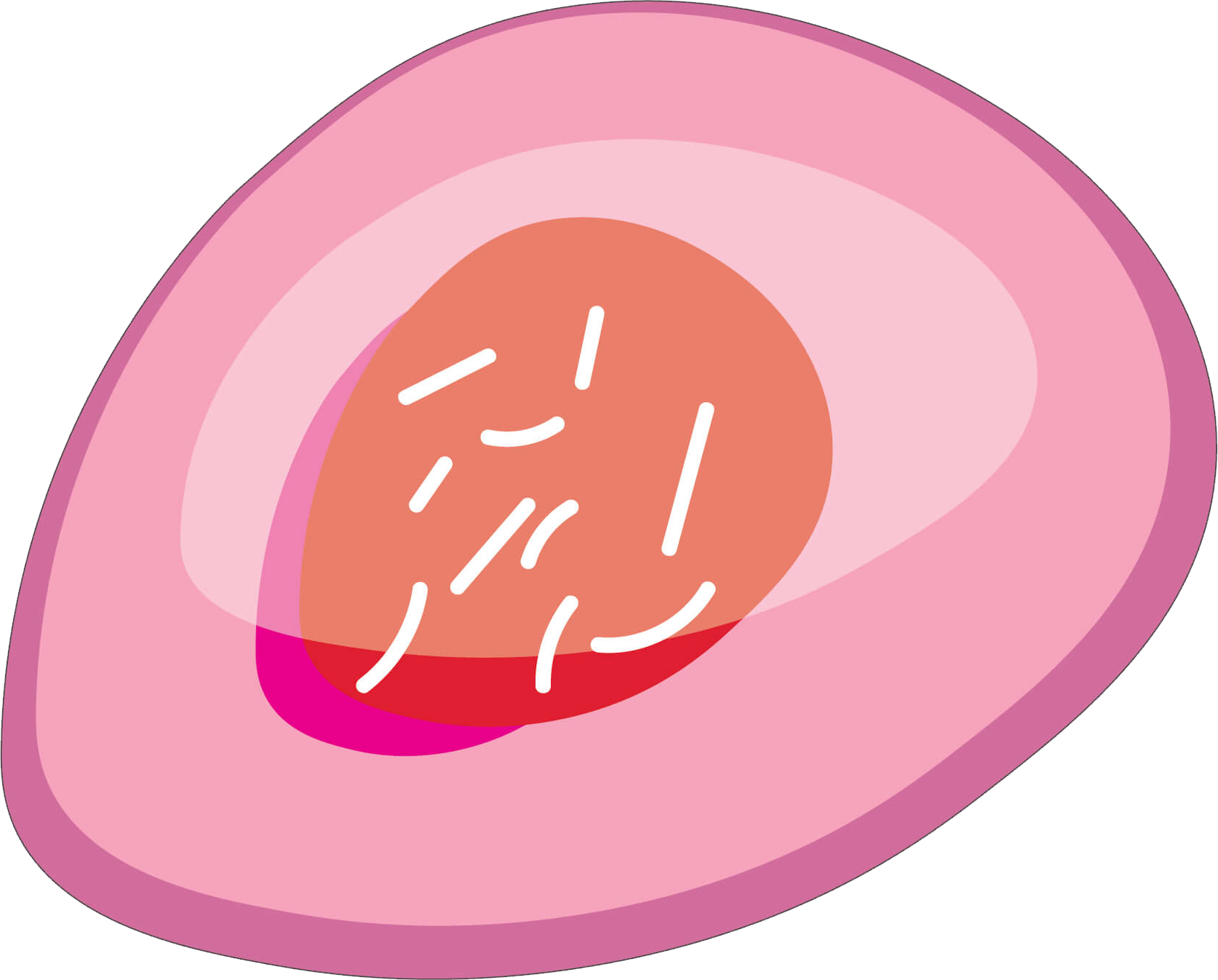 Cancerous cell with an abnormal number of chromosomes arranged in a disorganised fashion